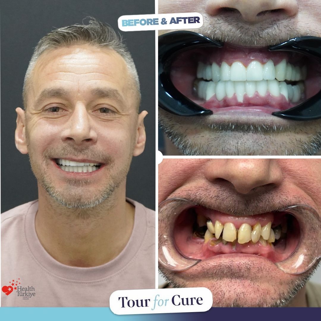 The name behind the smile transformation: Tour For Cure.

📞+90 546 110 10 90
🌐 h