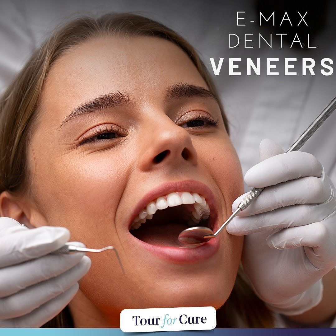 E-max veneers are high-quality porcelain shells applied to the front surface of 
