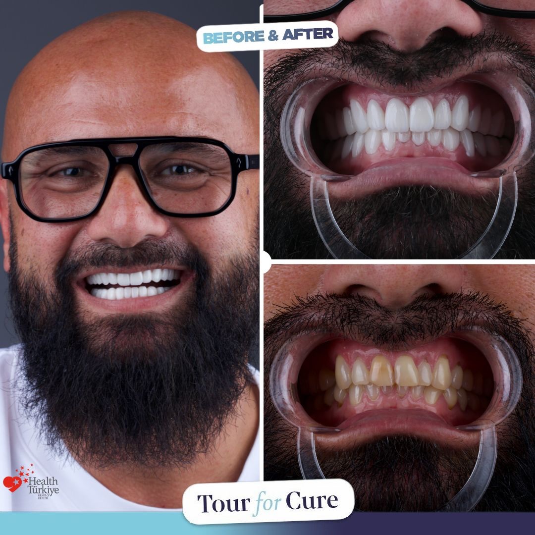 With Tour For Cure’s expert team, achieving your dream smile is possible!

📞+90 