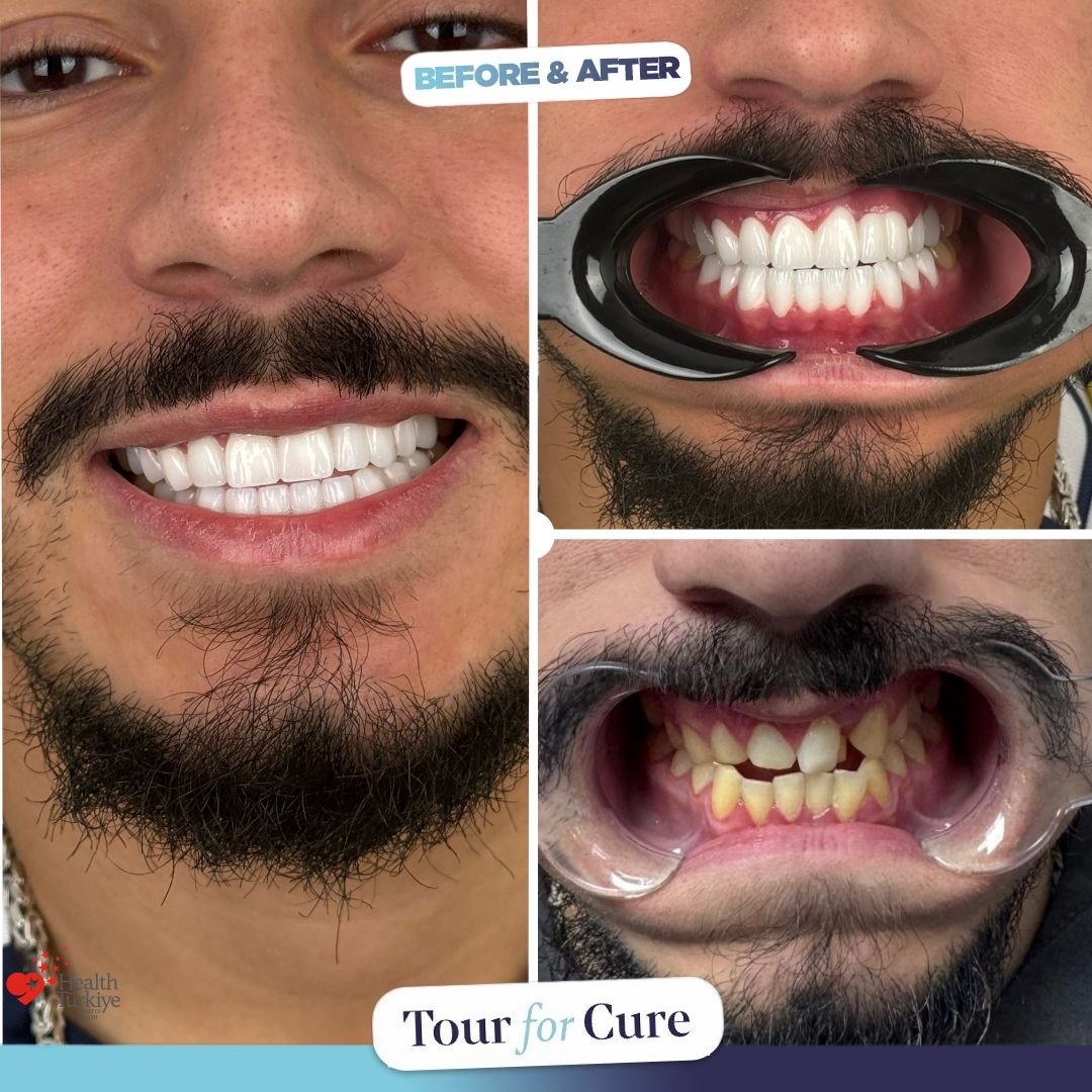 Healthy smiles, happy patients! 😁🦷 #DentalHealth #Smile #HealthySmiles

📞+90 546