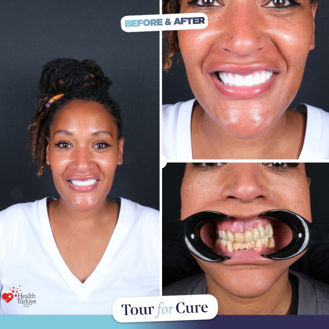 🌟 **A Beautiful Smile from Portugal!** 🌟

Our patient from Portugal brightened o