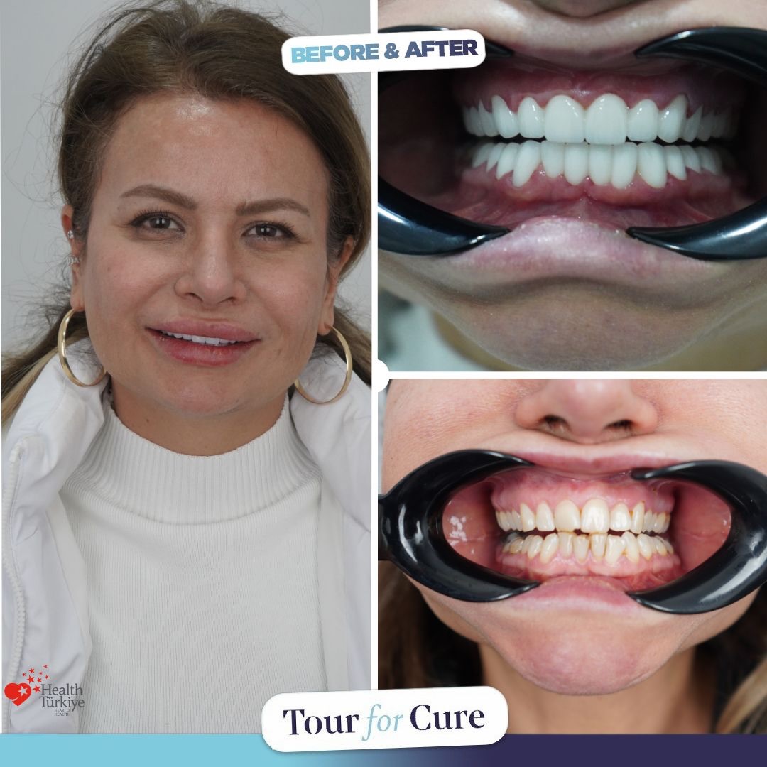 Bright and radiant smiles are possible with Tour For Cure! ✨😁

📞+90 546 110 10 9