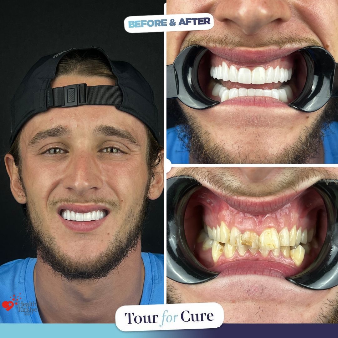 Healthy smiles, happy patients! 😁🦷 #DentalHealth #Smile #HealthySmiles

📞+90 546