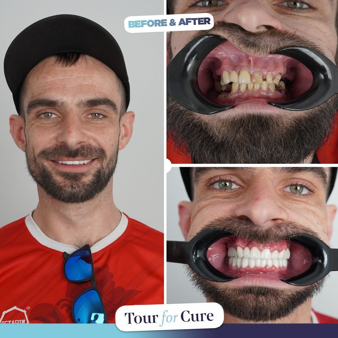 💎 “Your Smile Is Your Best Investment.”
This stunning transformation is no coinc