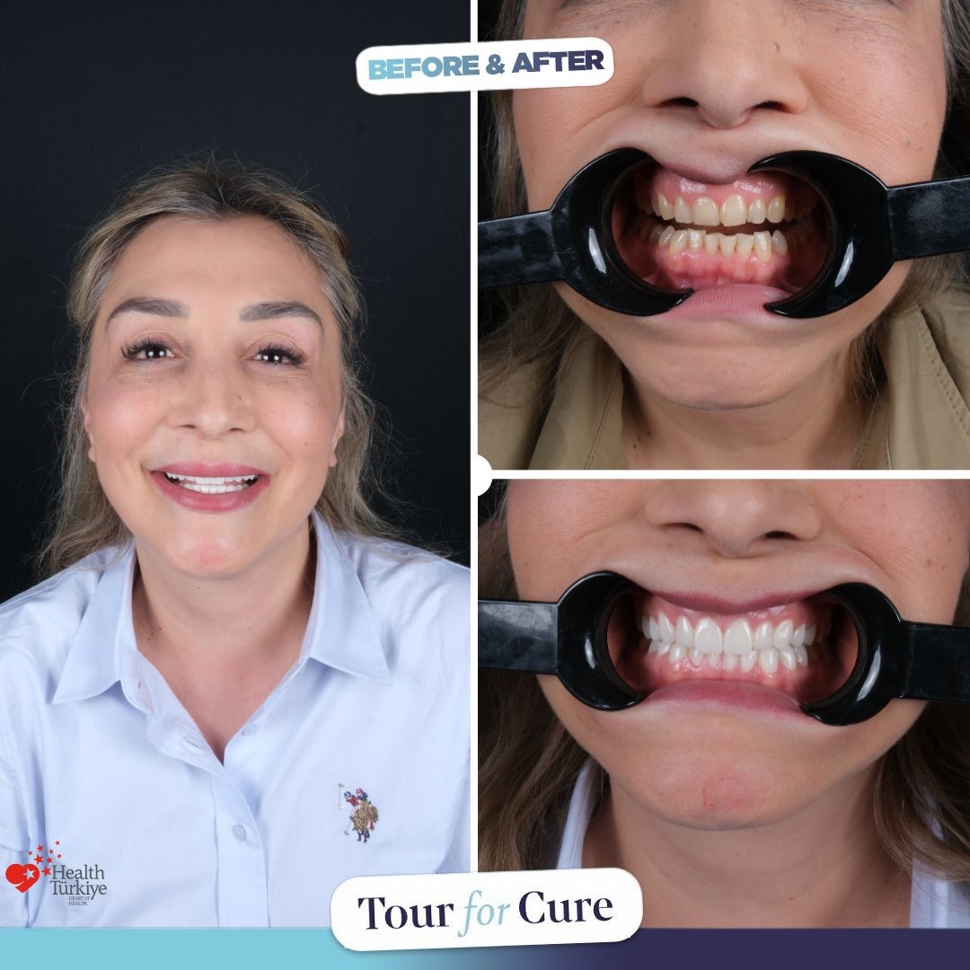 Meet our latest smile transformation! 🌟 Our patient chose us for their dental jo