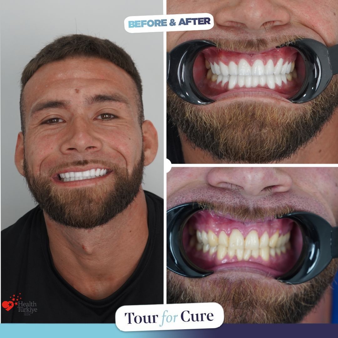 Healthy smiles, happy patients! 😁🦷 #DentalHealth #Smile #HealthySmiles

📞+90 546
