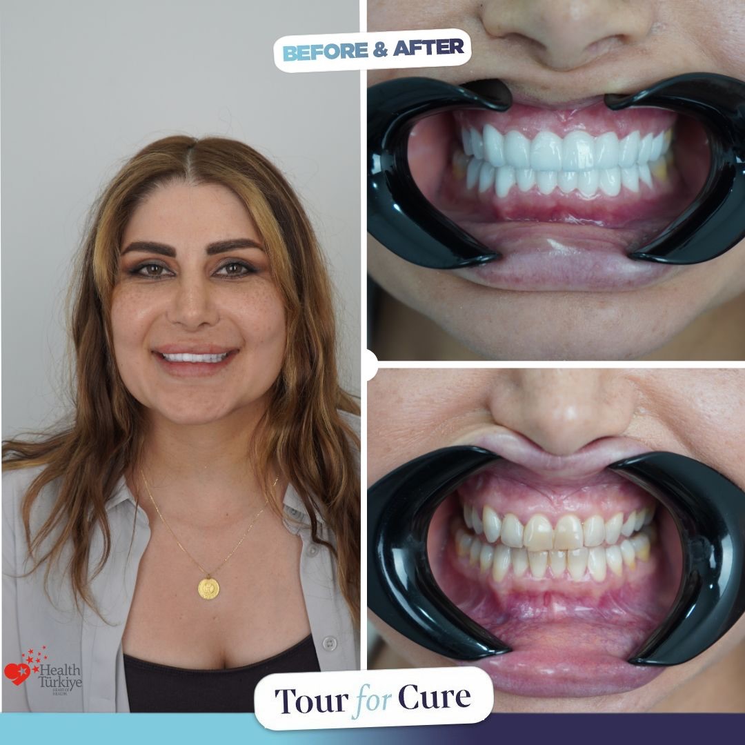 ✨ Before → After ✨
A confident new smile with 20 zirconia crowns. 🦷🤍
Every smile