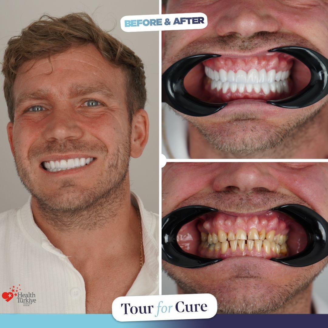 😬A perfect smile is crafted by expert hands. Achieve your perfect smile with Tou