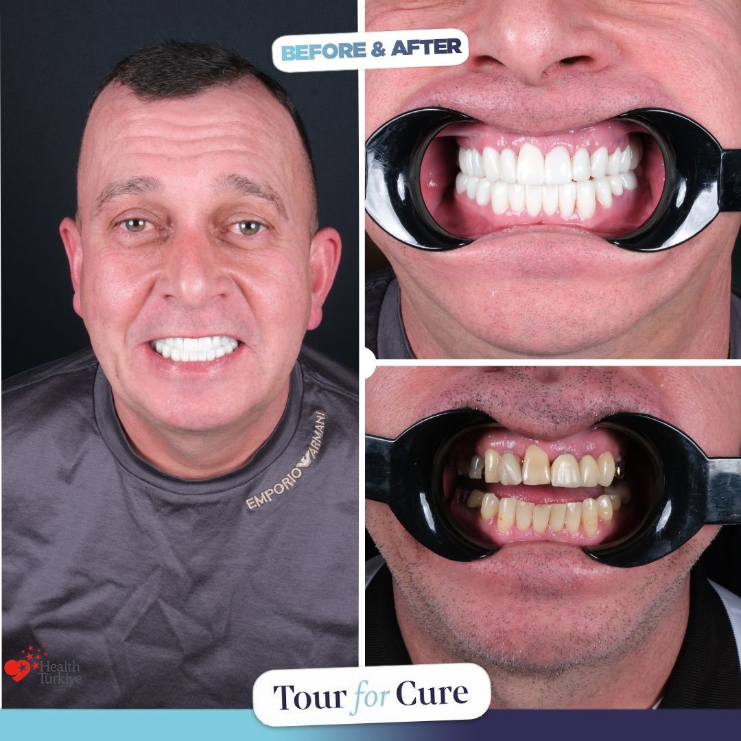 Healthy smiles, happy patients! 😁🦷 #DentalHealth #Smile #HealthySmiles

📞+90 546