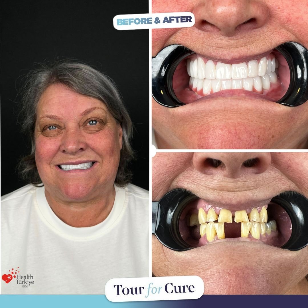 Bright and radiant smiles are possible with Tour For Cure! ✨😁

📞+90 546 110 10 9