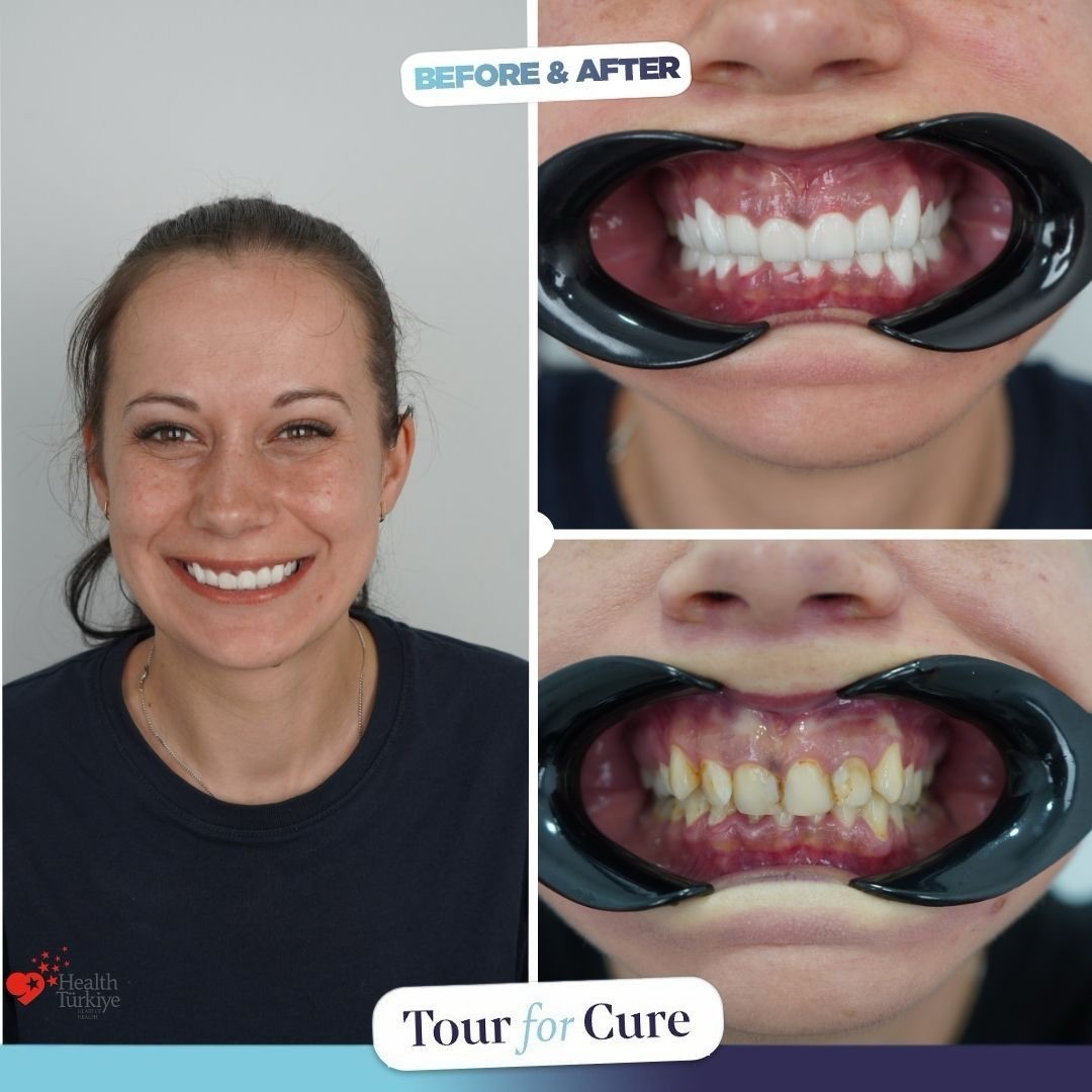 Meet our latest smile transformation! 🌟 Our patient chose us for their dental jo