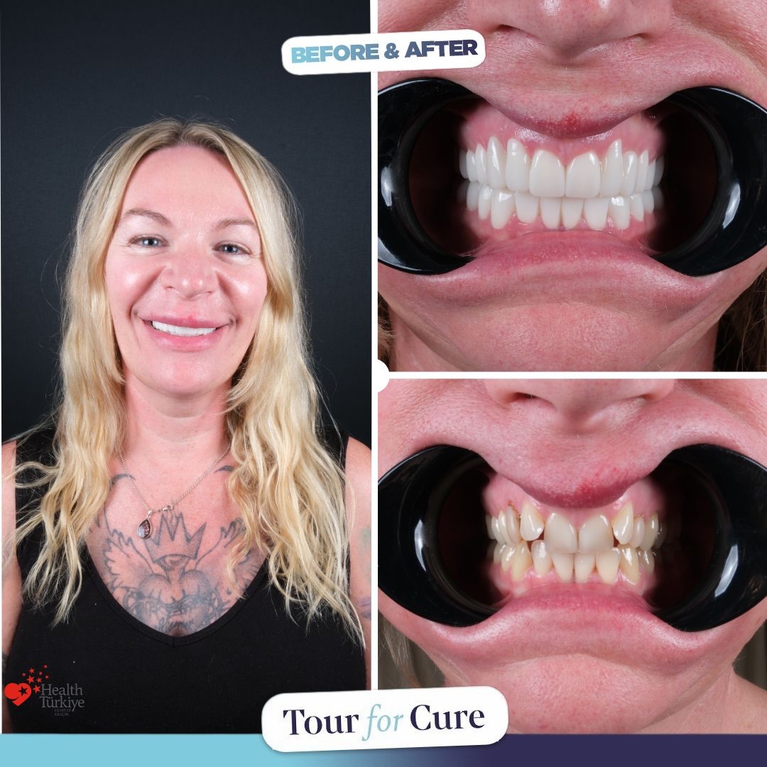 ✨Transformation begins♻️ with Tour For Cure! Now smiles are healthier, brighter,