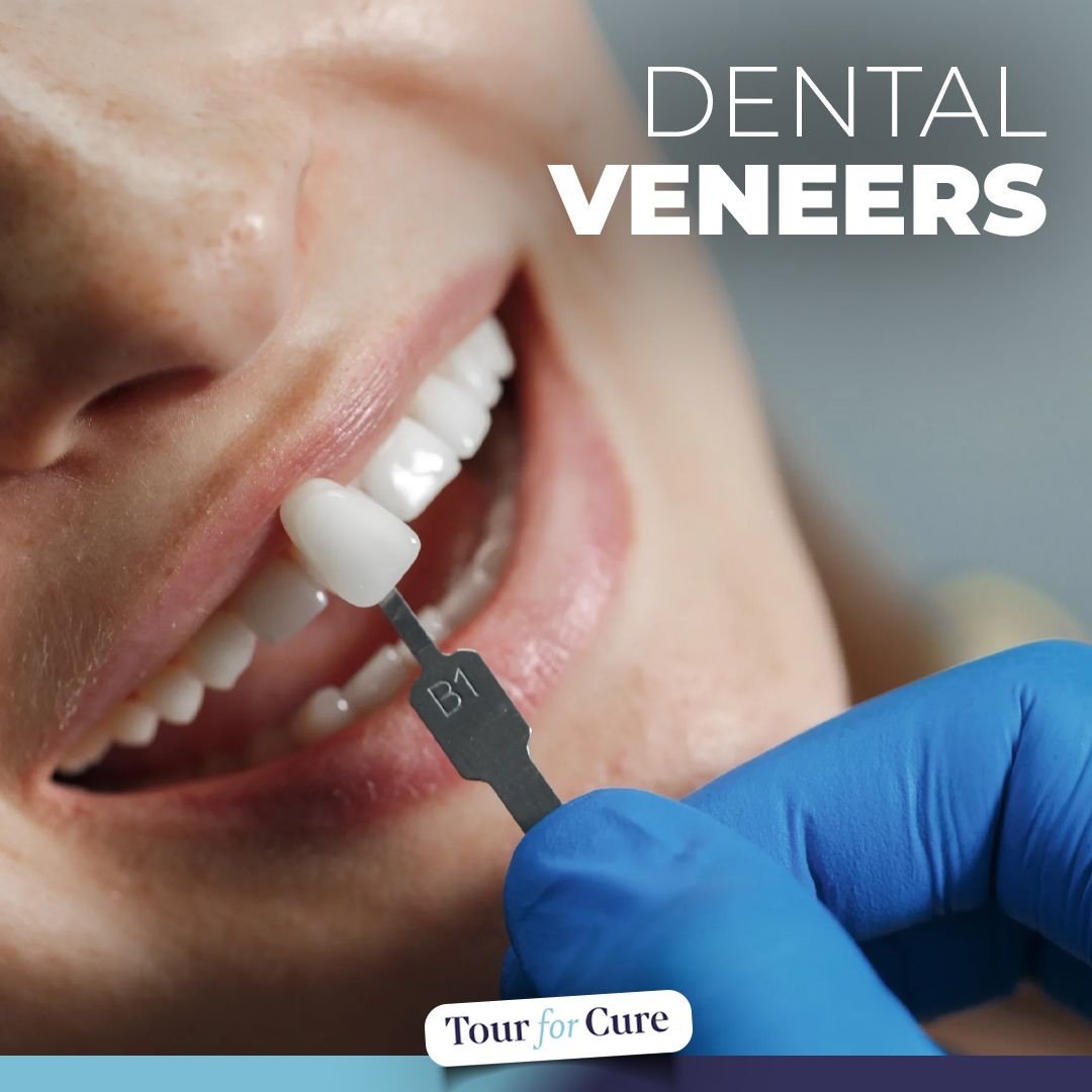 Dental Veneers or laminate veneers are covers that you can have them put on the 