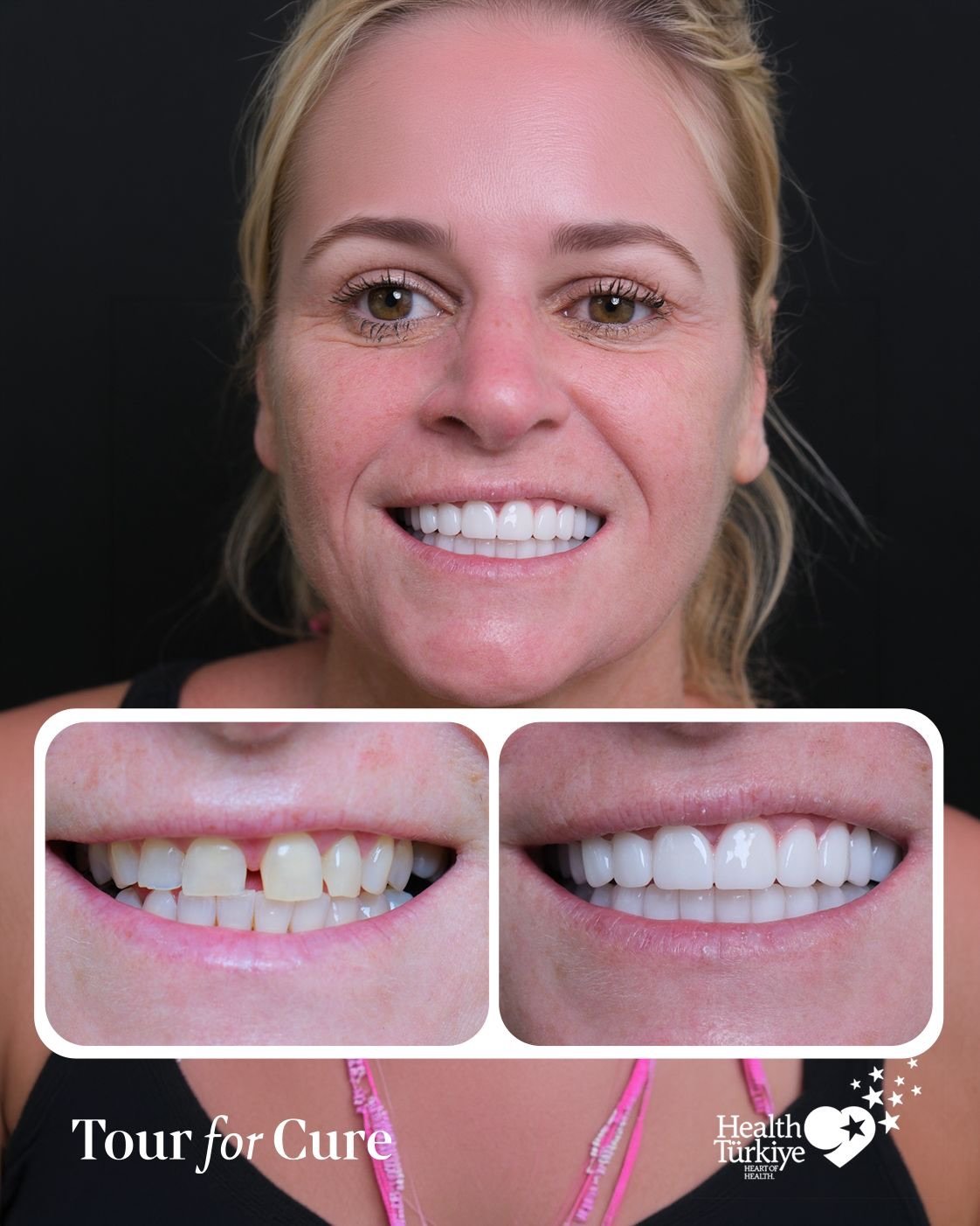 Another stunning smile transformation from the UK to Istanbul! 🇬🇧✨🇹🇷 Achieving h