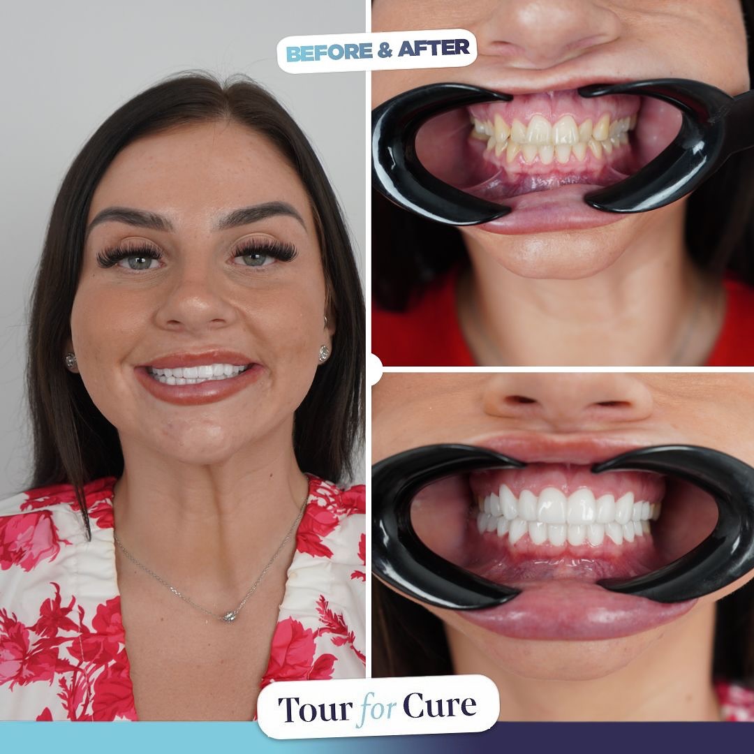 Bright and radiant smiles are possible with Tour For Cure! ✨😁

📞+90 546 110 10 9
